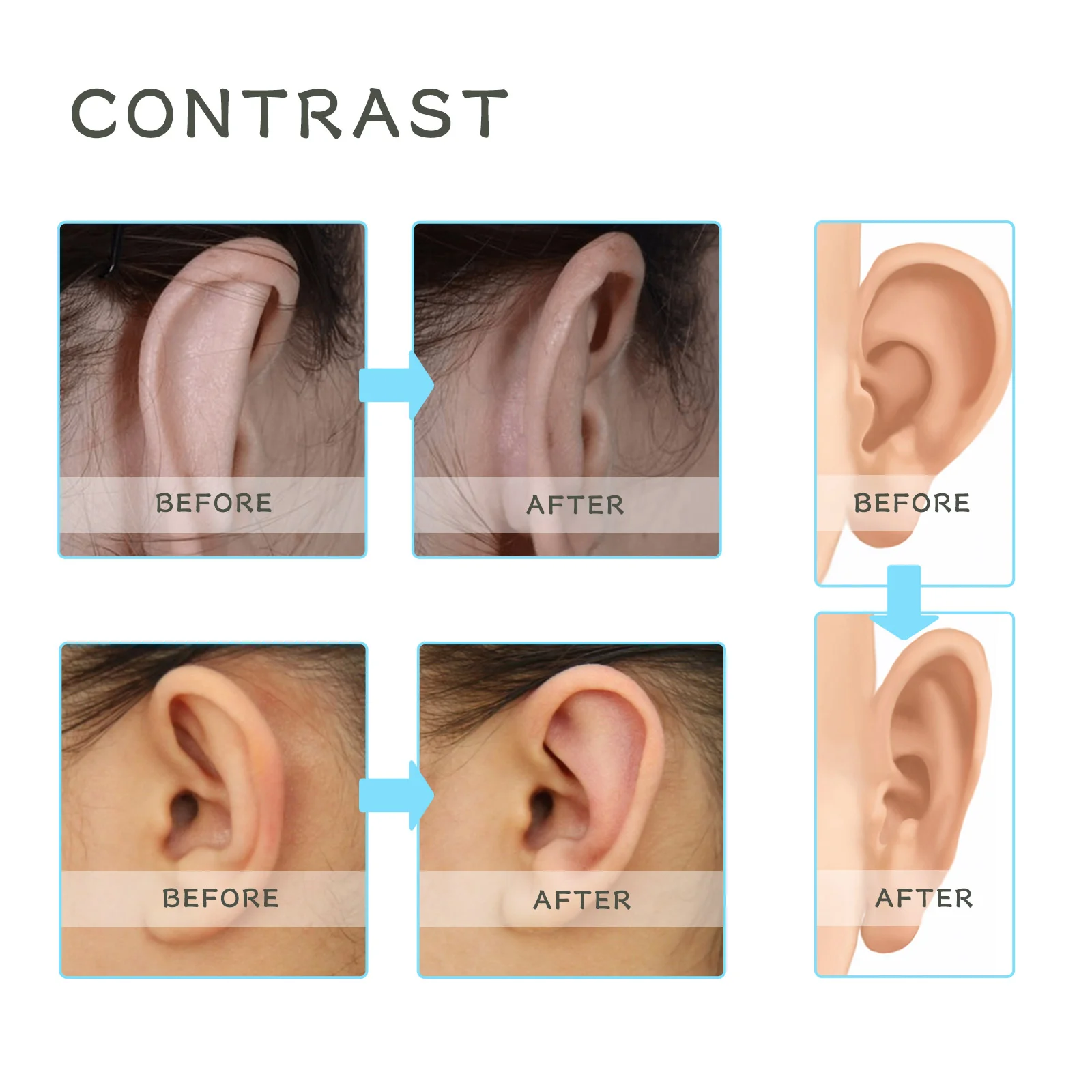 wiieey silicone ear correction patch WI HX 022 320