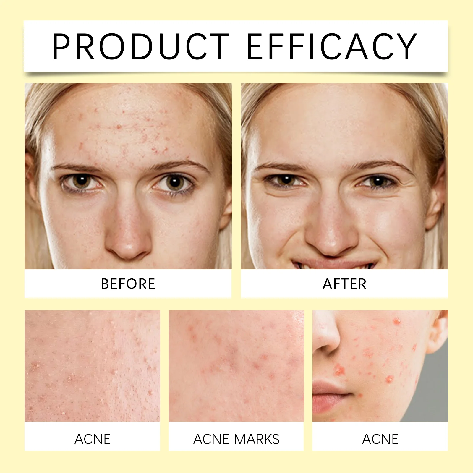 wiieey stars acne patch WI HX 035 501