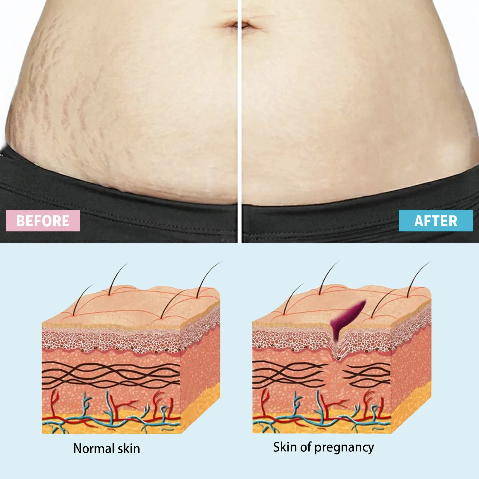wiieey stretch marks repair cream WI HX 033 473