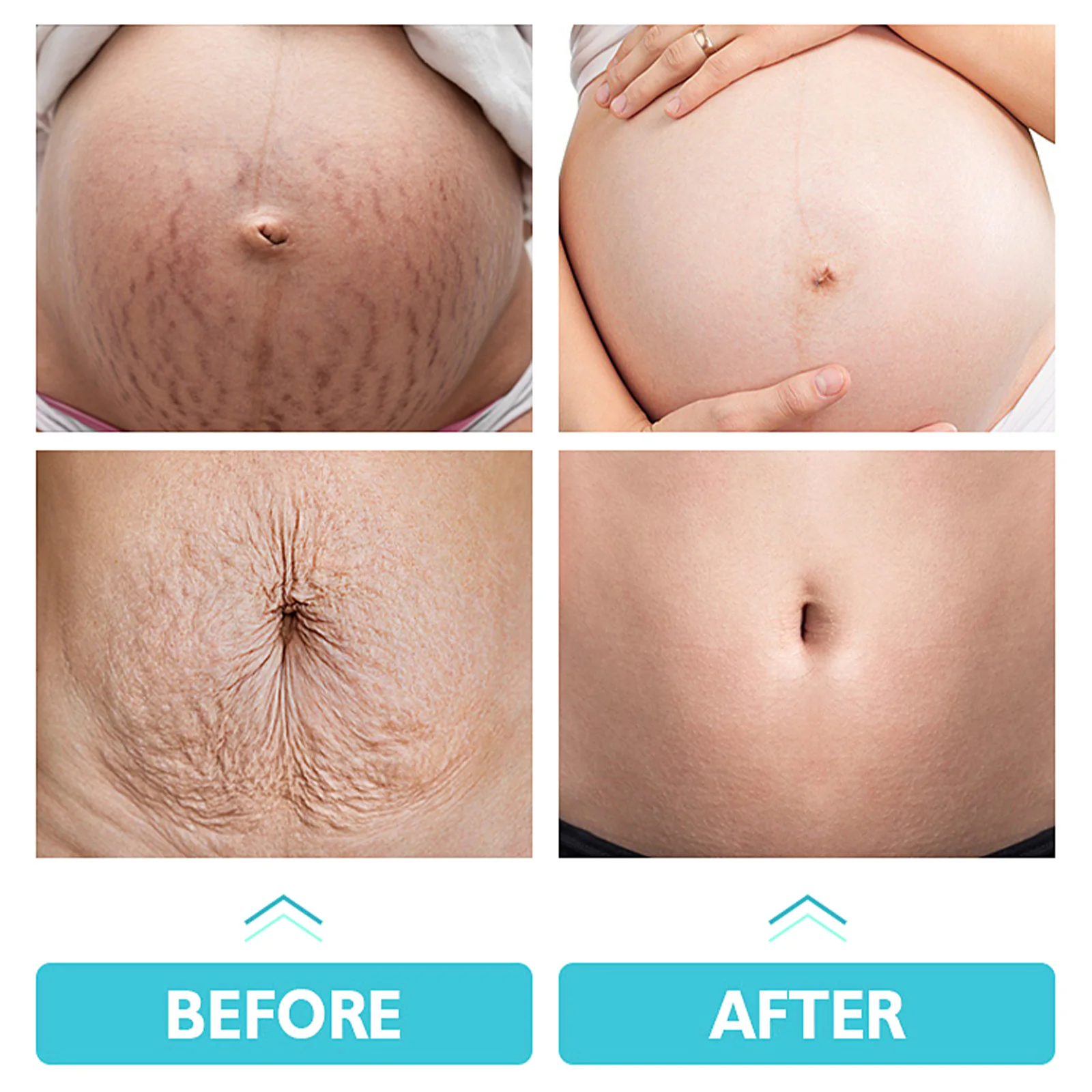 wiieey stretch marks repair cream WI HX 033 474